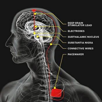 Brain Stimulation Comparison – The Brain Stimulator